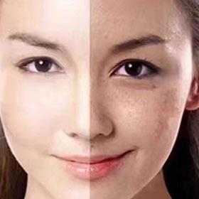 怎样祛斑最快最有效以及祛斑后注意事项有哪些？